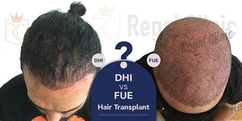 DHI Haartransplantatie Versus FUE: Wat Is Het Verschil?
