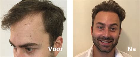 Haartransplantatie Behandeling: Klantverhalen En Ervaringen