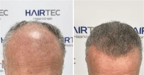 Haartransplantatie Bij Topische Haarverlies: Hoe Het Helpt