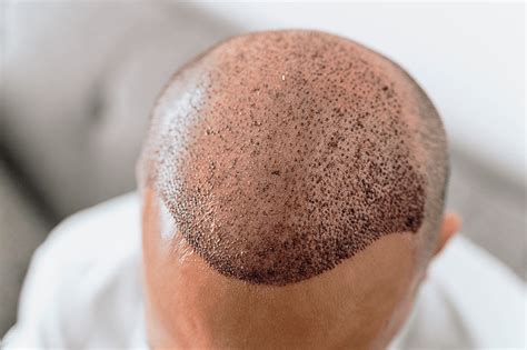 Haartransplantatie En Haaruitval: Wat Je Moet Weten